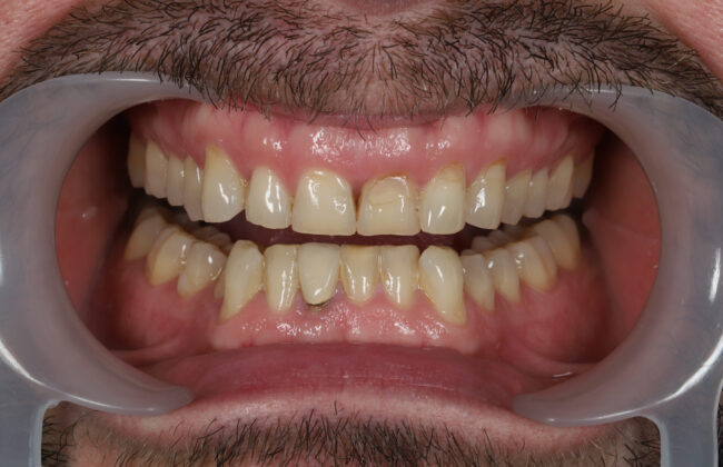 Before (Teeth)