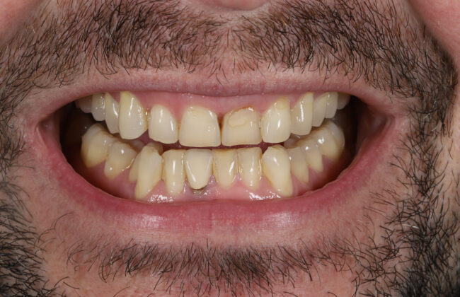 Before (Teeth)