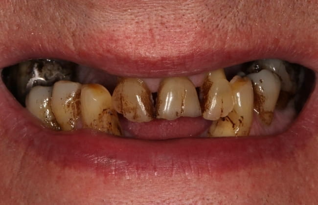 After (Teeth)