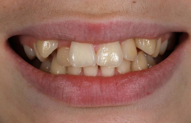 After (Teeth)