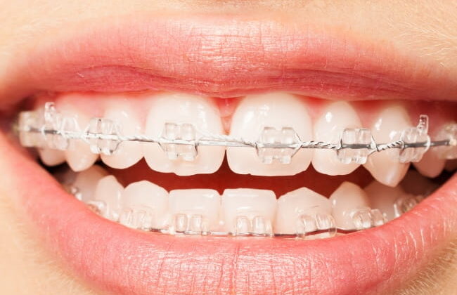 After (Teeth)